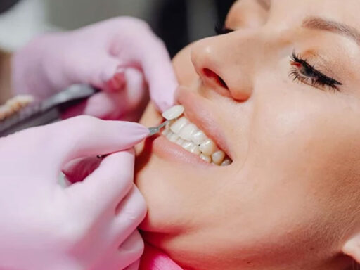 Faccette dentali: quando sceglierle e perché sono tanto apprezzate?