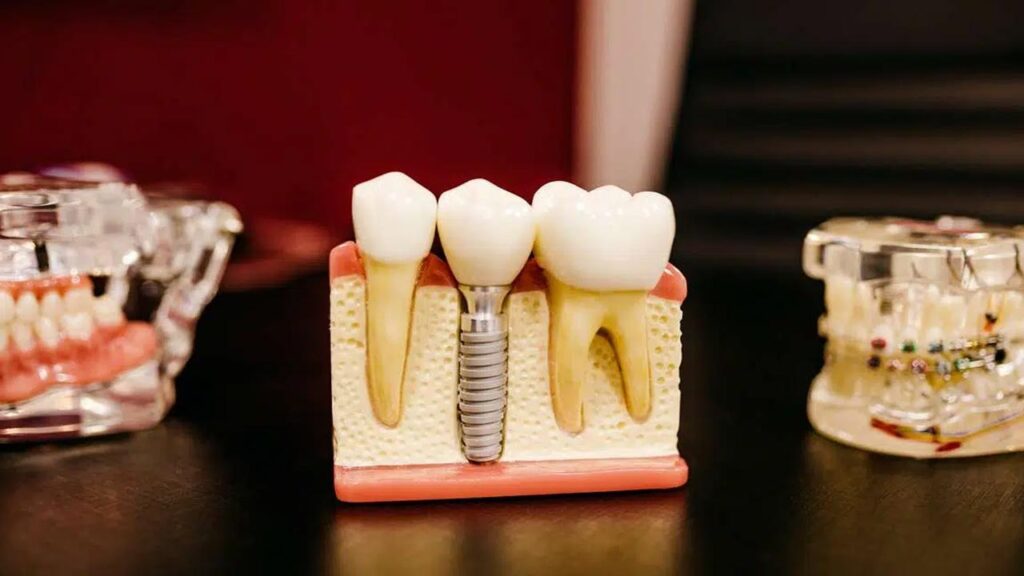 Implantologia a carico immediato: la soluzione per ripristinare il sorriso?