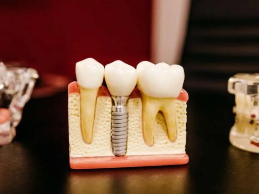 Implantologia a carico immediato: la soluzione per ripristinare il sorriso?